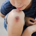 Close-up photo of a bruise on a young boy's knee