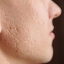Acne 名詞 にきび の意味 使い方 読み方 Dmm英会話words
