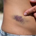 A purple bruise on a man's hip
