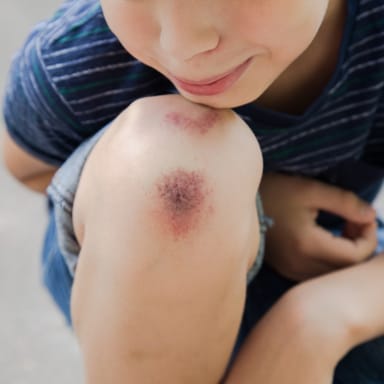 bruise (【Substantivo】hematoma, escoriação, hematoma/machucado