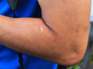 A closeup of a person arm with goosebumps