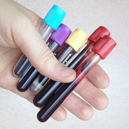 Test Using Drop of Blood Can Reveal Person’s Viral Infection History ...